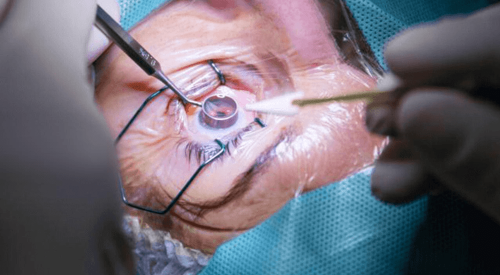 Cornea Ophthalmology