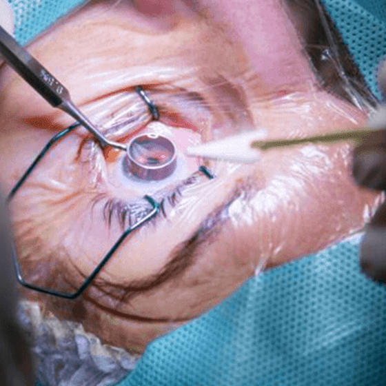 Cornea Ophthalmology