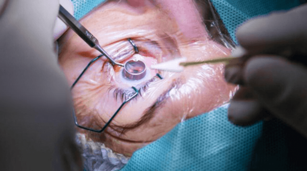 Cornea Ophthalmology